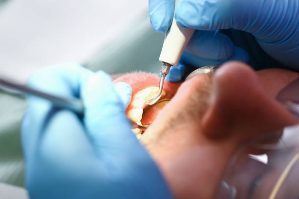 Best Emergency Dental Care for Broken or Chipped Teeth in Ferndale, PA
